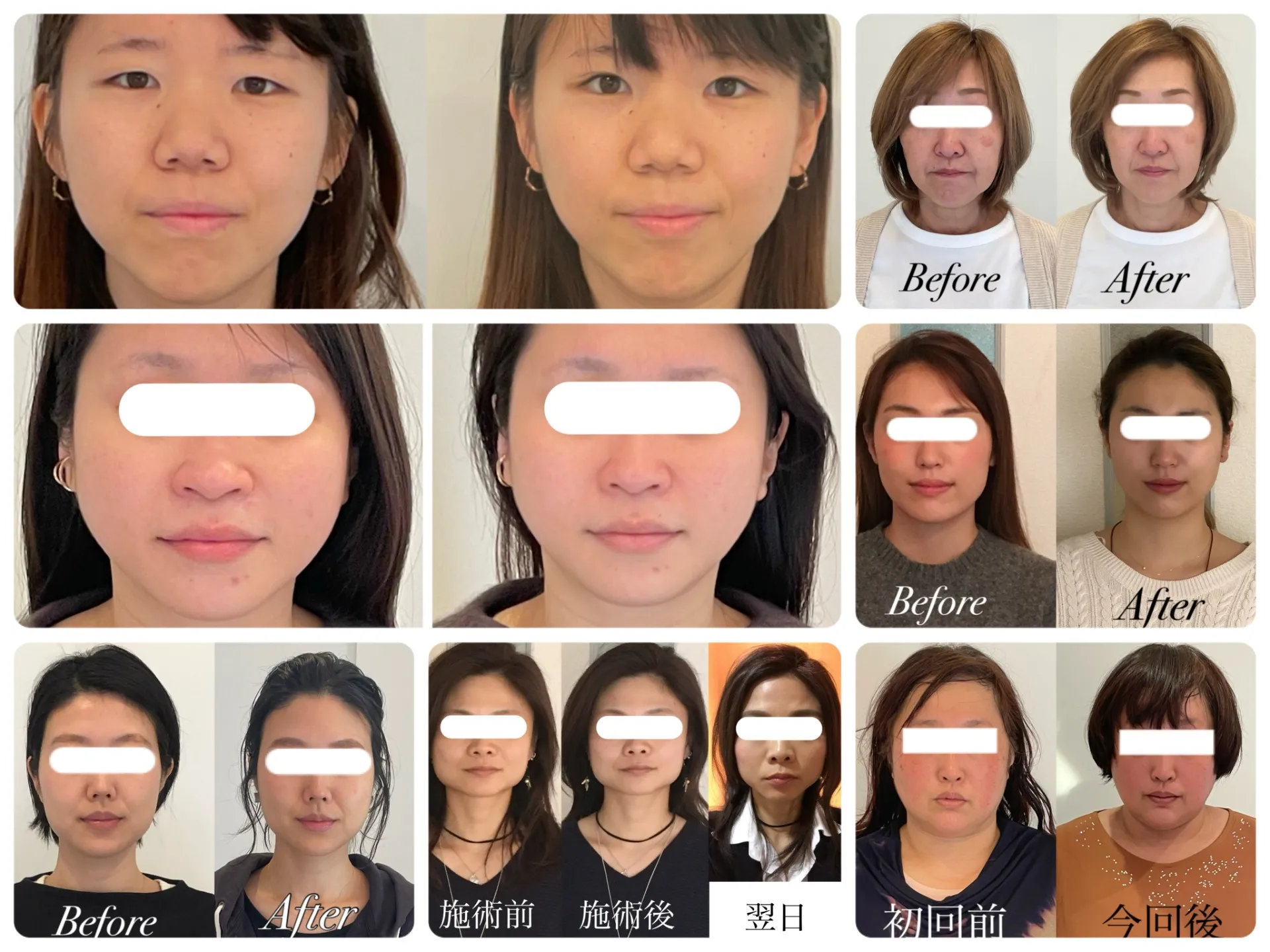 【京都市伏見区】小顔矯正って、どんな人に向いているの?